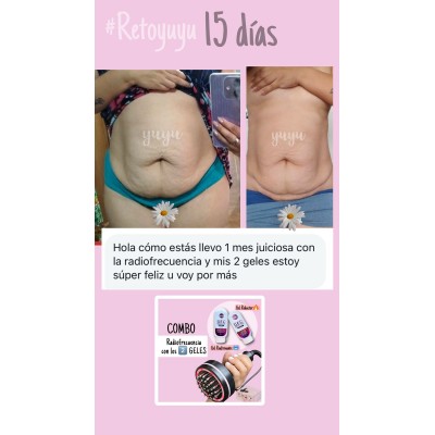 Complementa tu GYM con Radiofrecuencia, Faja Vibro y Criolipolisis.