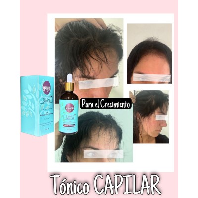 YUYU-FOR-YOU-RADIO-CAPILAR-COMBO RADIOFRECUENCIA CAPILAR Y TONICO ANTI CAIDA